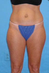 CoolSculpting