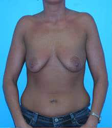 Breast Augmentation with Breast Lift