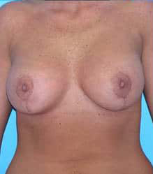 Breast Augmentation with Breast Lift