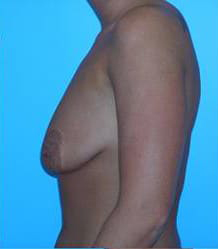 Breast Augmentation with Breast Lift