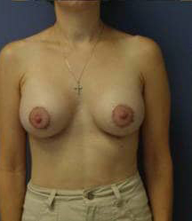 Breast Augmentation with Breast Lift