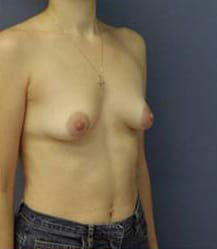 Breast Augmentation with Breast Lift