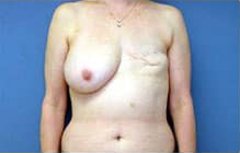 Breast Reconstruction with Flaps