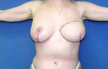 Breast Reconstruction with Flaps