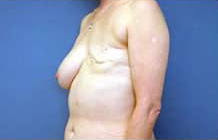 Breast Reconstruction with Flaps