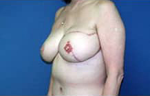 Breast Reconstruction with Flaps