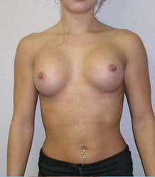 Breast Augmentation (Silicone)