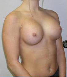 Breast Augmentation (Silicone)