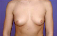 Asymmetric Breast Augmentation