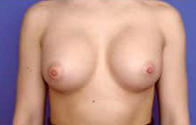 Asymmetric Breast Augmentation