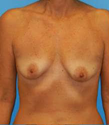 Breast Augmentation (Silicone)