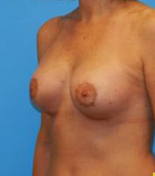 Breast Augmentation (Silicone)