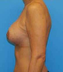 Breast Augmentation (Silicone)