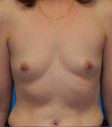 Breast Augmentation (Silicone)