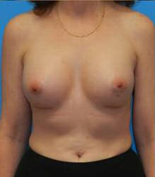 Breast Augmentation (Silicone)