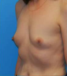 Breast Augmentation (Silicone)