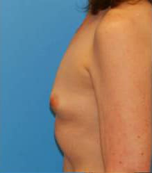 Breast Augmentation (Silicone)