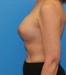 Breast Augmentation (Silicone)