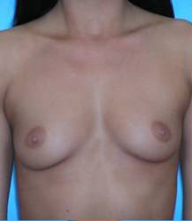 Breast Augmentation (Silicone)