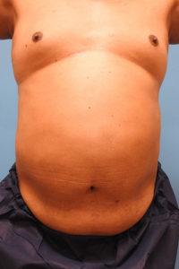 CoolSculpting