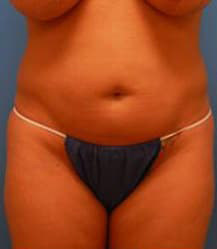 Liposuction