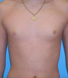 Gynecomastia