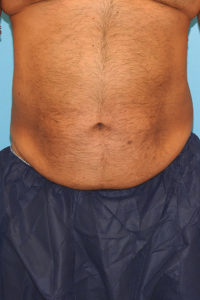 CoolSculpting