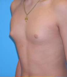 Gynecomastia