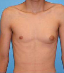 Gynecomastia