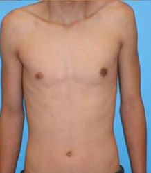 Gynecomastia