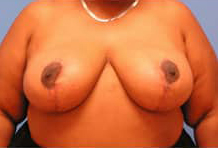 Breast Reduction