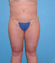 Liposuction