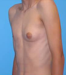 Gynecomastia