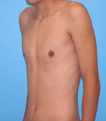 Gynecomastia