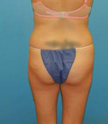 Liposuction