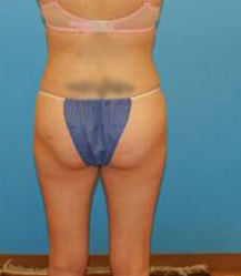 Liposuction