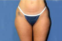 Liposuction