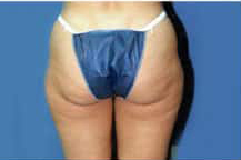 Liposuction