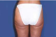 Liposuction