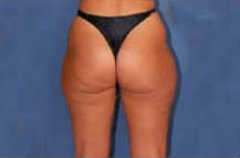 Liposuction