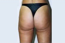 Liposuction