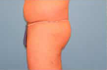 Liposuction