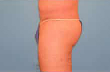 Liposuction