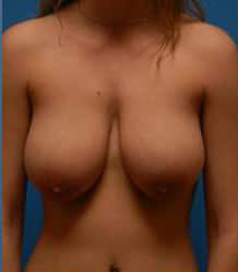 Breast Reduction