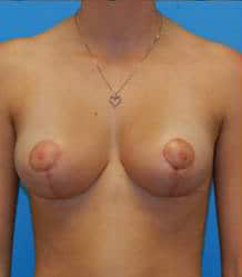 Breast Reduction