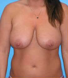 Breast Reduction