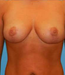 Breast Reduction