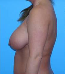 Breast Reduction