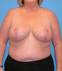 Breast Reduction