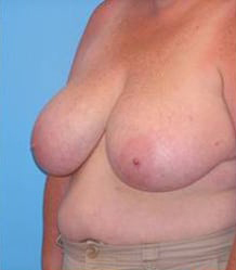 Breast Reduction